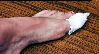 Compresses for the treatment of fungi on the big toe