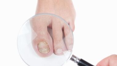 How to treat a fungus on the big toe