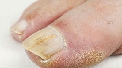 Reasons for appearing the fungus on the big toe