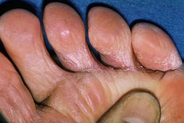 Fungus on the toes