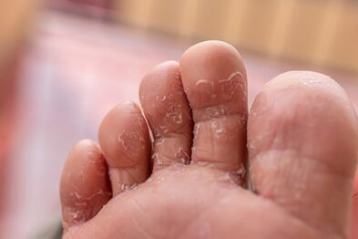 symptoms of toe fungus