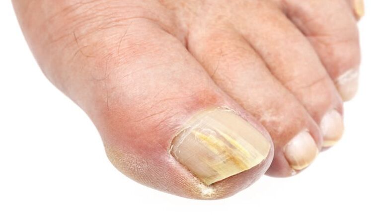 the external change in the nails is a sign of fungal infection