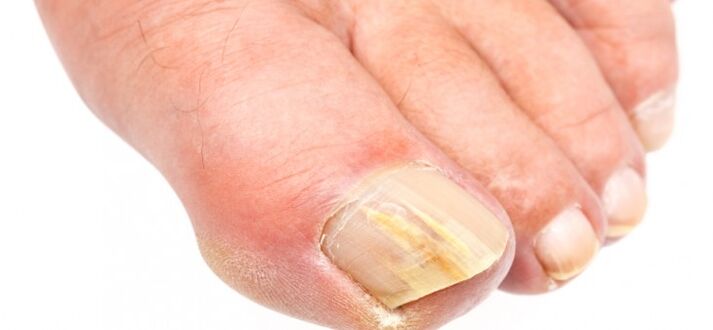 toenails affected by mold
