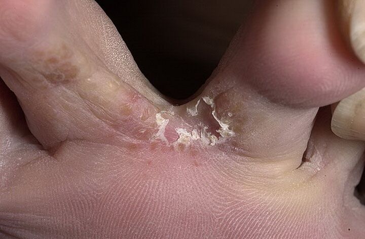Cracked skin between the toes is a symptom of intertriginous fungus
