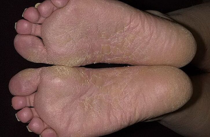 Dry, cracked skin on the feet is a sign of scaly mycosis